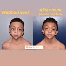 Famous Noonan Syndrome, Understanding the Condition and Inspiring Stories